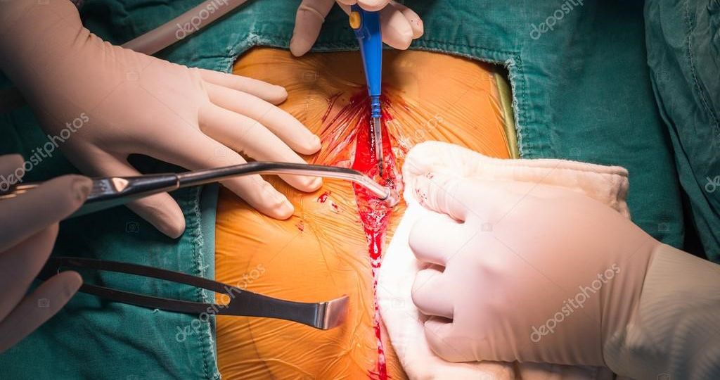 esternotomia mediana bjcvs jan19