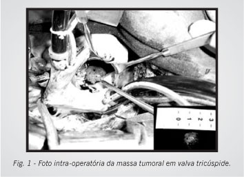 fibroelastoma papilar