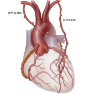 Enxerto bilateral de ATI