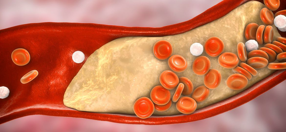 coronary-artery-disease-feature