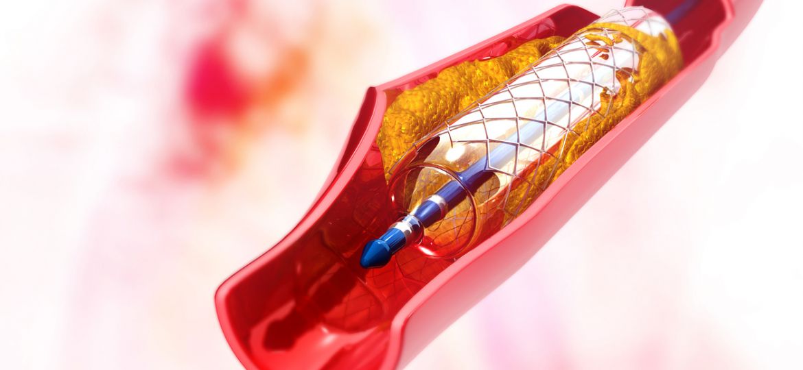 Stent angioplasty. 3d illustration"n"n